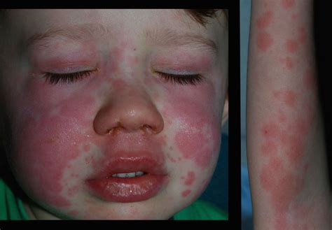 Erythema Multiforme Like Eruption In A 3 Year Old Boy Archives Of