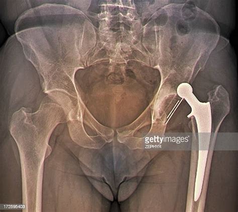 False Hips Photos And Premium High Res Pictures Getty Images