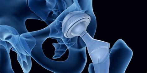 Total Joint Replacement | EmergeOrtho—Triangle Region