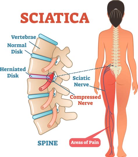 What Causes Sciatica And Nerve Pain Laser Spine Center