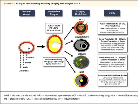 Figure 1 From Sex Based Differences In Acute€coronary€syndromes