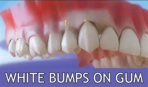 White Bump On Gums Causes And Treatment