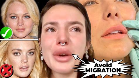 BEFORE YOU GET LIP FILLERS WATCH THIS How To Avoid MIGRATION BOTCHED LIPS YouTube