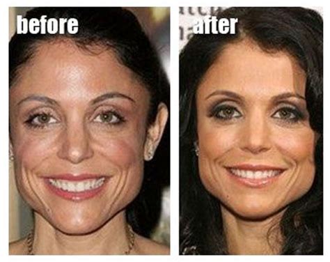 Celebrity Plastic Surgery Before And After 56 Pics