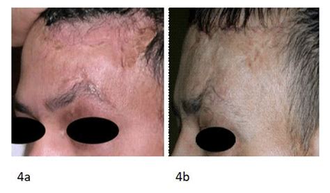 Patient Presenting For Forehead Scar 1 Year Post Burn Apreoperative