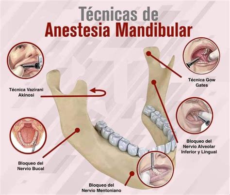 Tecnicas De Anestesia Anestesia En Odontologia Anestesia Dental