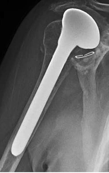 Uw Shoulder And Elbow Academy Bone Preserving Humeral Component