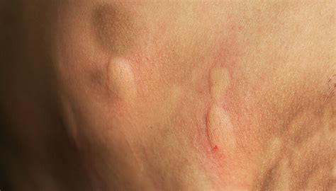 Identifying Common Insect Bites And Stings Sentinel Blog