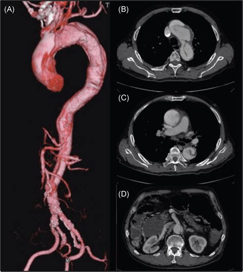 Preoperative Computed Tomography Ct Revealed Type A Acute Aortic
