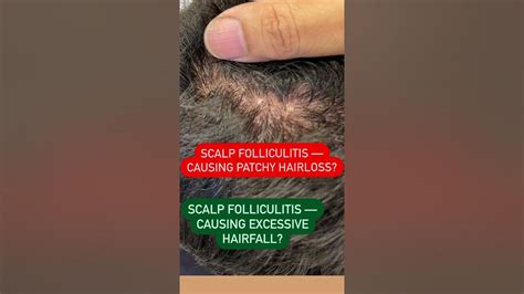 Scalp Folliculitis Treatmenthairfall Treatment Dr Ashima Goel