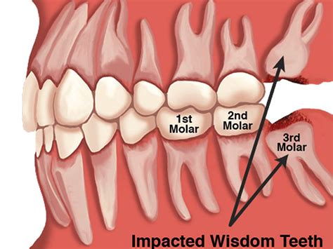 How To Know If Wisdom Teeth Really Need To Be Removed Directorio