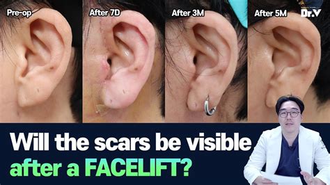 Facelift Faq Will The Scars Be Visible After A Facelift Youtube
