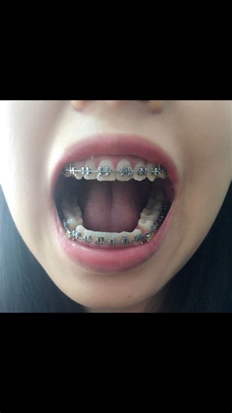 pin by shrood burgos on beautiful braces braces tips cute braces braces girls