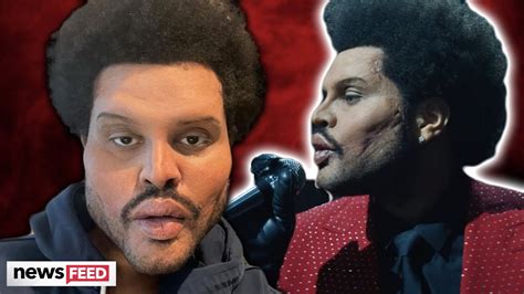 The Weeknd Debuts Wild Plastic Surgery Look And Fans Are Shocked Youtube