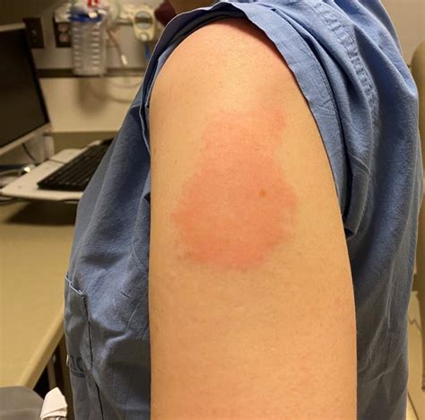 Covid Study Moderna Arm Vaccine Rash No Worse With Second Shot