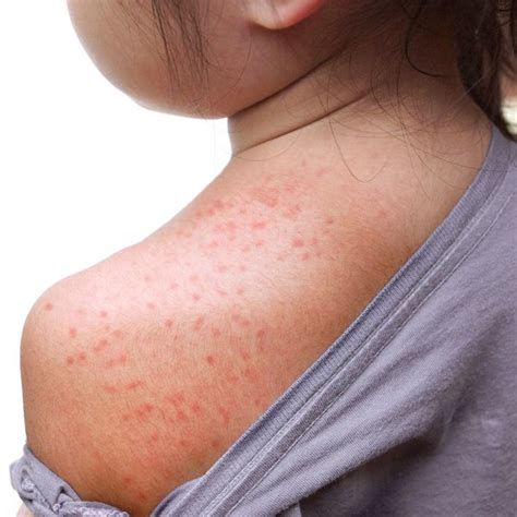 Common Reasons Behind That Itchy Skin Rash