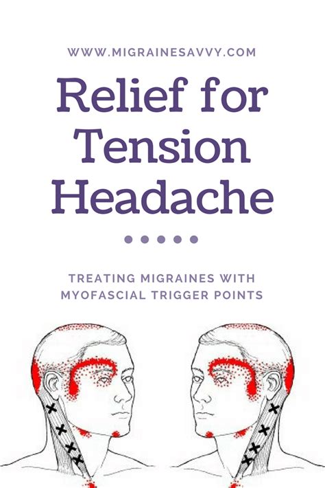 Myofascial Trigger Points Relief For Tension Headache