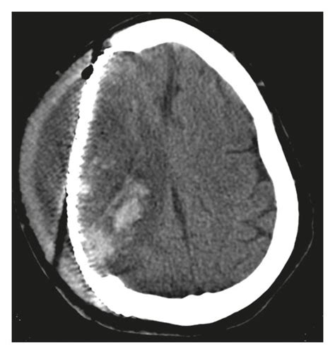 Head Ct Revealing An 18 Mm Subgaleal Fluid Collection Overlying The
