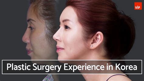 Plastic Surgery Experience In Korea Youtube