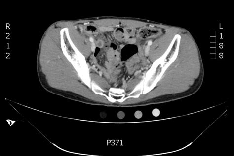 Computed Tomography Diagnosis Of Appendicitis Jetem