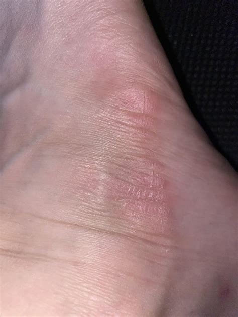 Foot Rash Dermatologyquestions