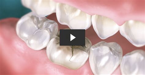 How To Repair A Cracked Tooth With A Crown