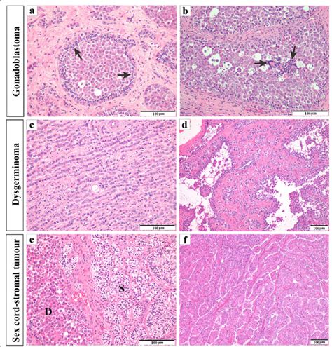 Histological Features Of The Three Neoplastic Lesion Components
