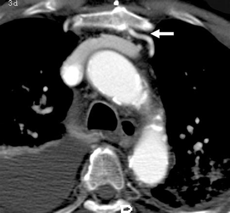 Multisection Ct Evaluation Of The Reoperative Cardiac Surgery Patient