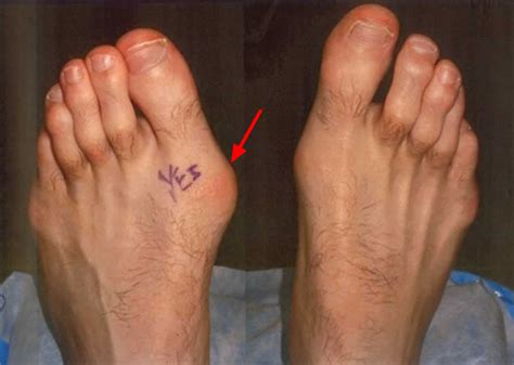 Turf toe injuries result in pain at the base of the great toe. Turf toe causes, signs, symptoms, recovery, diagnosis ...