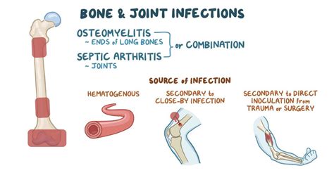 Pediatric Bone And Joint Infections Clinical Video Osmosis
