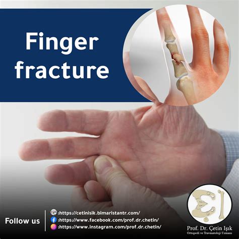 broken finger diagnostic and treatment methods prof dr Çetin işık