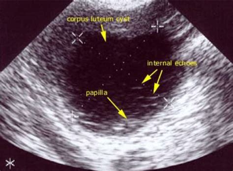 Transvaginal Ultrasound Showing The Corpus Luteal Cyst Download