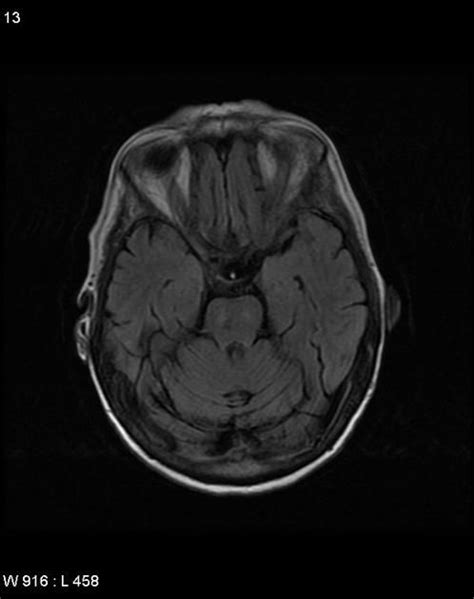 Cerebritis Radiopaedia Dr Henry Knipe And Dr Marcos Gil Alberto Da