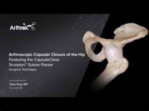 Arthroscopic Capsular Closure Of The Hip Featuring The Capsuleclose