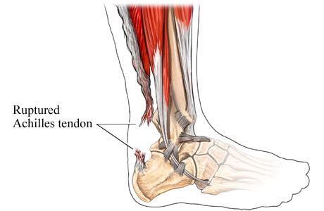 Diagram of tendons in hand stock illustration. Night Falls and Autumn Leaves: April 2012