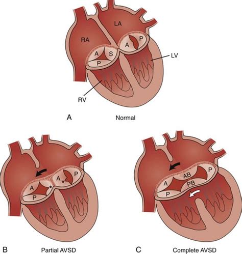 Septal Defects Clinical Gate