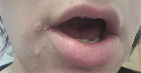 Bumps And Peeling Around Corner Of Lips Imgur