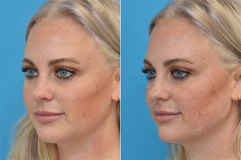 Injectable Fillers Photos Philadelphia Pa Patient 1553