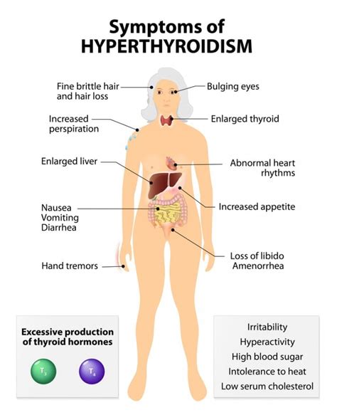 Overactive Thyroid Hyperthyroidism What Are The Symptoms