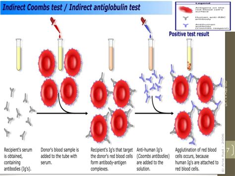 Antiglobulin test, also referred to as coomb's test, is a frequently employed diagnostic tool that is used for the detection of immunohematological and immunological disorders. Prueba De Coombs Directa - SEONegativo.com