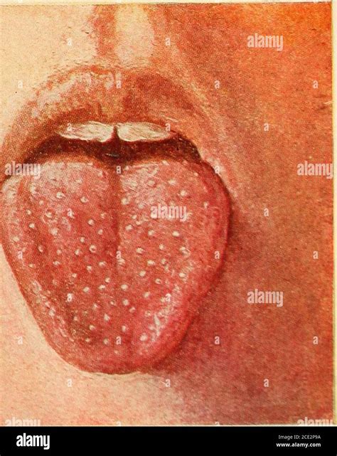 Diseases Of Infancy And Childhood Strawberry Tongue In Scarlet