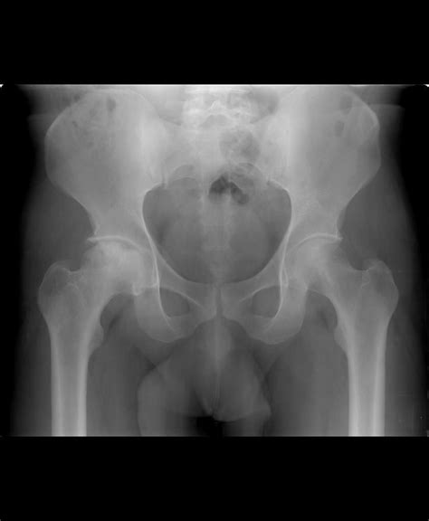 Avascular Necrosis Of The Hip Radiology Case