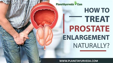 How To Treat Enlarged Prostate Bobby Vincents Blog