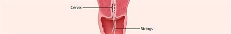 Iuds containing copper can increase menstrual bleeding. IUD Self-Removal | ANSIRH