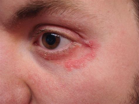 Eyelid Dermatitis Xeroderma Of The Eyelids Eczema Atopic Derma