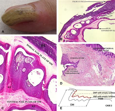 Onychomatricoma With Dorsal Pterygium Pathogenic Mechanisms In 3 Cases