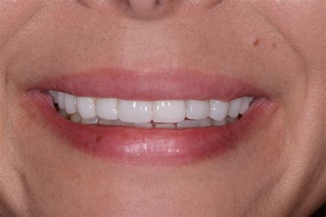 Check spelling or type a new query. Before and After No-Prep G. Lewis Veneers Photos