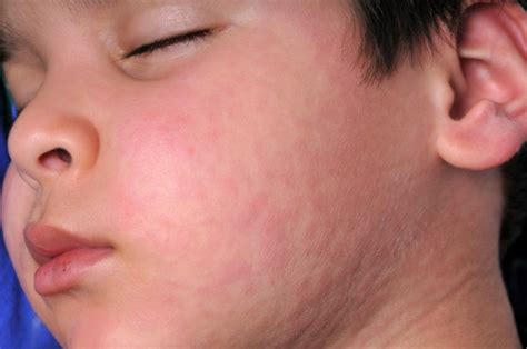 Facial Skin Allergies Naked Images