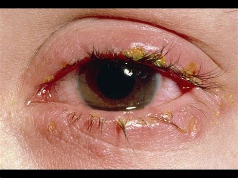 The condition is a type of mucormycosis, which is a fungus infection causing a nasal infection. Eye Diseases, Black Floaters In Eye, Floater Eye, What Are ...