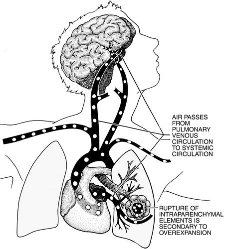 Arteriële gasembolie en decompressieziekte fysiologie ACM Blog